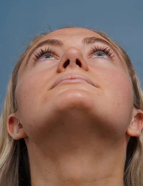 after rhinoplasty front heads up view female patient case 1711