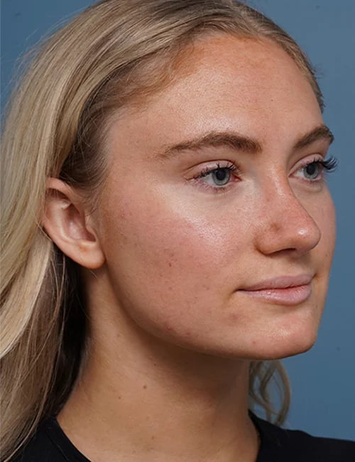 after rhinoplasty right angle view female patient case 1711