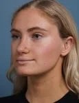 after rhinoplasty left angle view female patient case 1711
