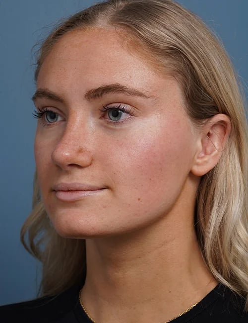 after rhinoplasty left angle view female patient case 1711