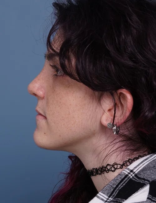 after rhinoplasty left side view female patient case 1724