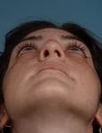 before rhinoplasty front heads up view female patient case 1724