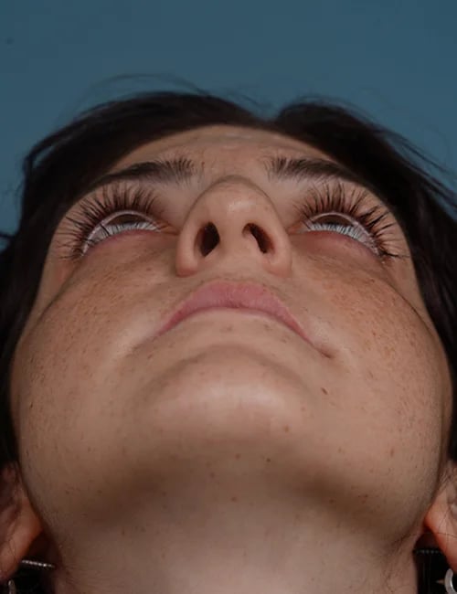 before rhinoplasty front heads up view female patient case 1724