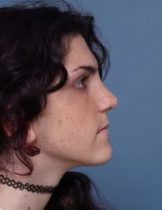 after rhinoplasty right side view female patient case 1724