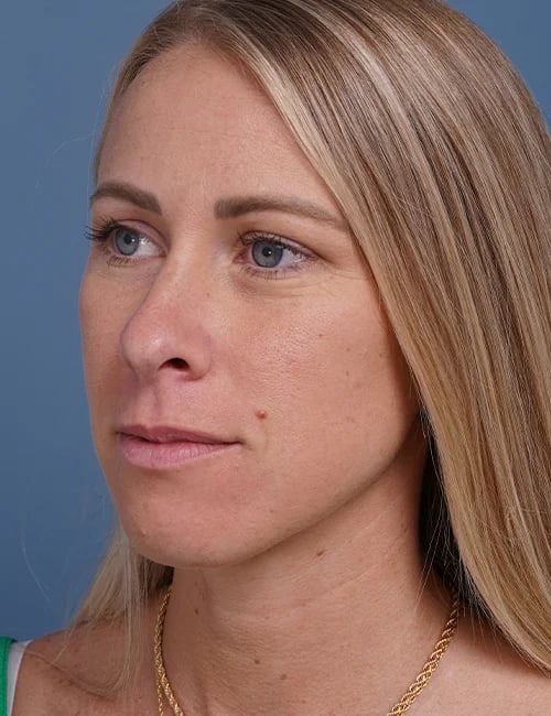 before rhinoplasty left angle view female patient case 1737