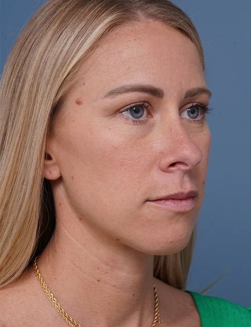 before rhinoplasty right angle view female patient case 1737