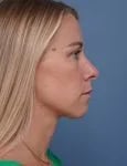 before rhinoplasty right side view female patient case 1737