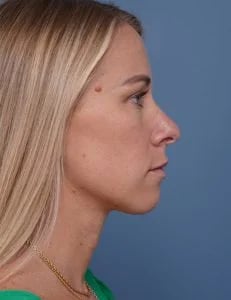 before rhinoplasty right side view female patient case 1737