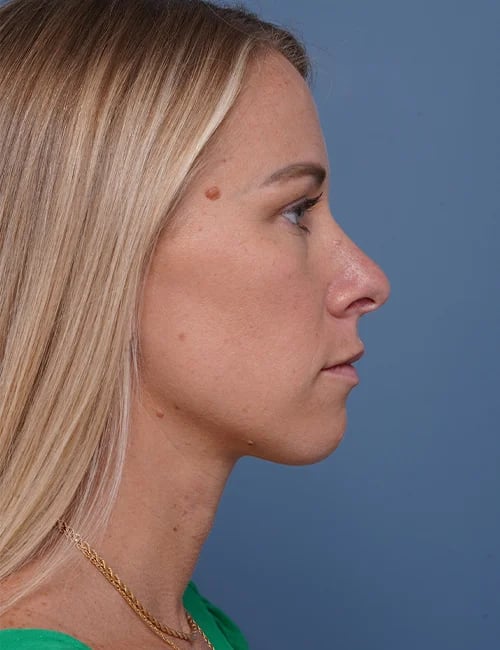 before rhinoplasty right side view female patient case 1737