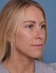 after rhinoplasty right angle view female patient case 1737