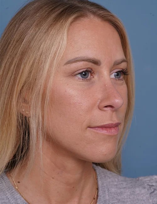 after rhinoplasty right angle view female patient case 1737
