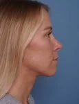 after rhinoplasty right side view female patient case 1737
