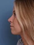 after rhinoplasty left side view female patient case 1737