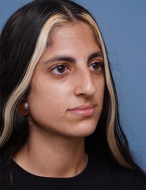 Before Rhinoplasty Female Patient right Diagonal Angle View Case 1750 Palm Beach, FL