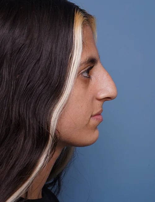 Before Rhinoplasty Female Patient Right Side angle view Case 1750 Palm Beach, FL