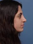 After Rhinoplasty Female Patient side angle view Case 1750 Palm Beach, FL