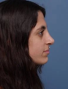 After Rhinoplasty Female Patient side angle view Case 1750 Palm Beach, FL