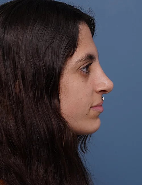 After Rhinoplasty Female Patient side angle view Case 1750 Palm Beach, FL