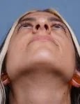 before rhinoplasty female patient looking up view case 1750 Palm Beach, FL