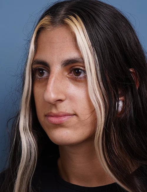 before rhinoplasty female patient left diagonal view case 1750 Palm Beach, FL