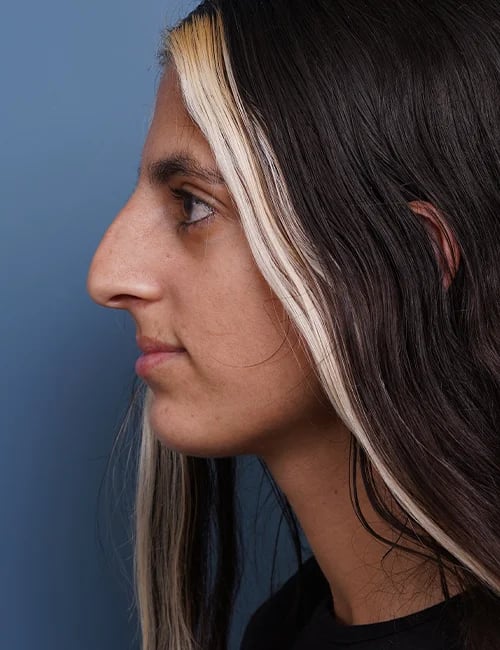 Before Rhinoplasty Female Patient Left Side Angle View Case 1750 Palm Beach, FL