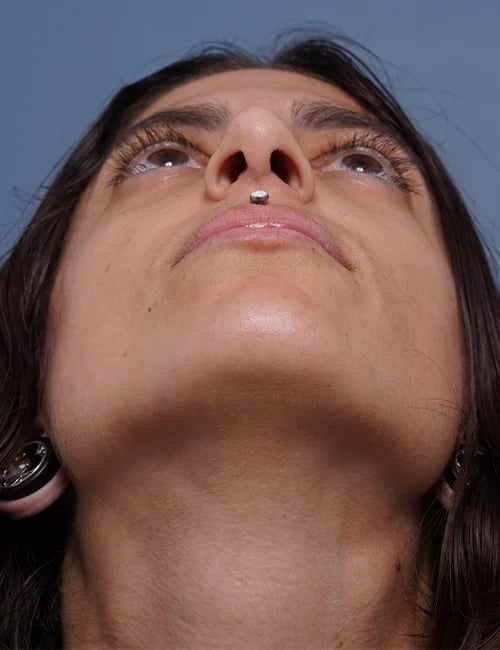 after rhinoplasty female patient looking up view case 1750 Palm Beach, FL