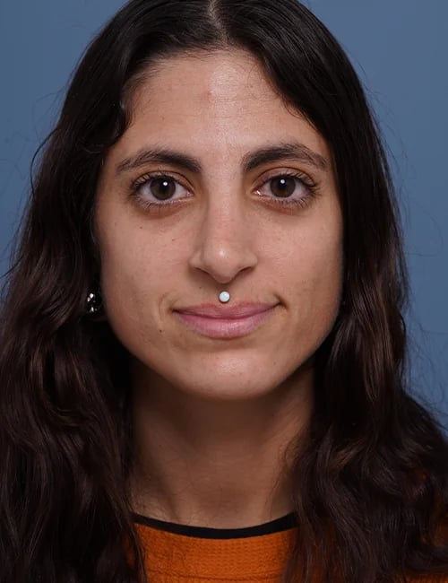 after rhinoplasty female patient front view case 1750 Palm Beach, FL