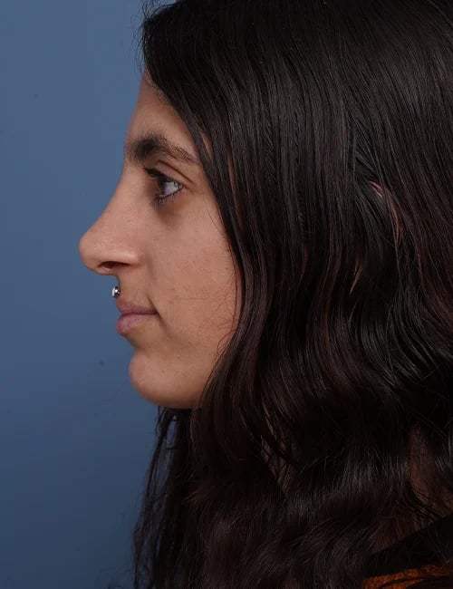 after Rhinoplasty Female Patient Left Side View Case 1750