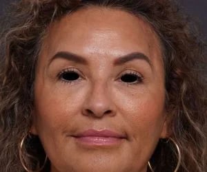 after brow lift front view female patient case 2088