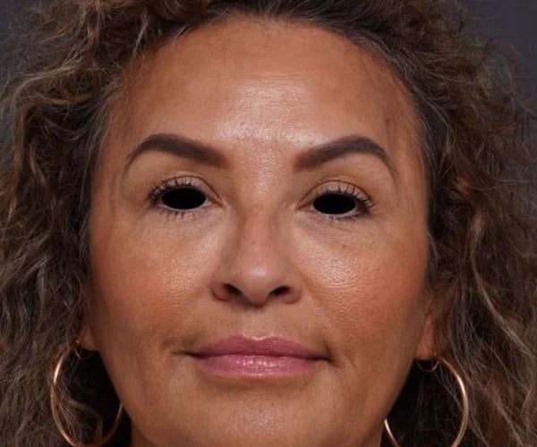 after brow lift front view female patient case 2088