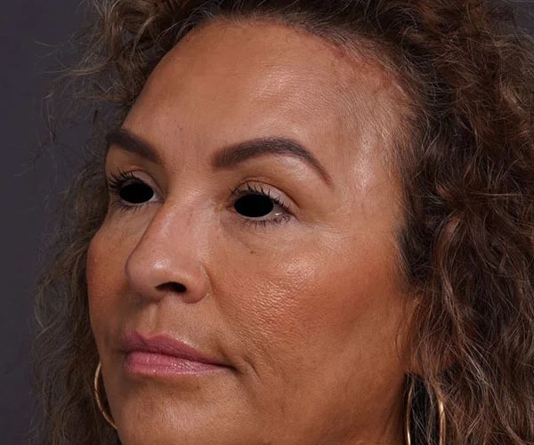 after brow lift left angle view female patient case 2088