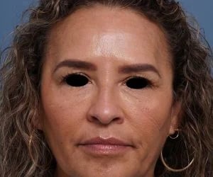 before brow lift front view female patient case 2088