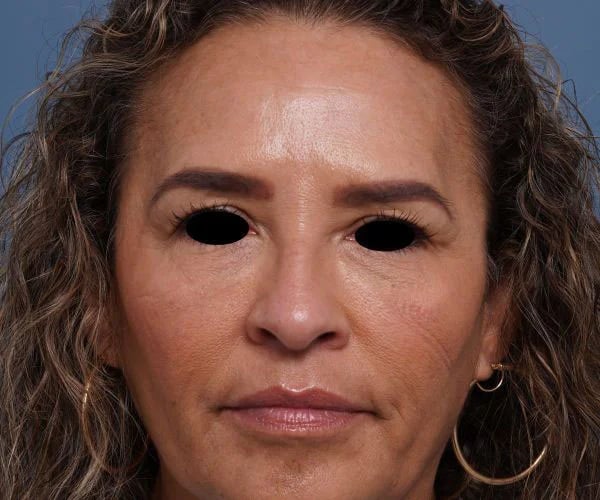 before brow lift front view female patient case 2088