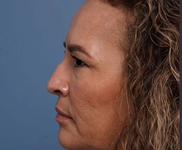 before brow lift left side view female patient case 2088
