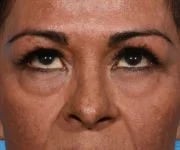 before brow lift front eyes up view female patient case 2103