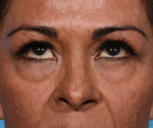 before brow lift front eyes up view female patient case 2103