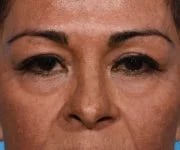 before brow lift front view female patient case 2103