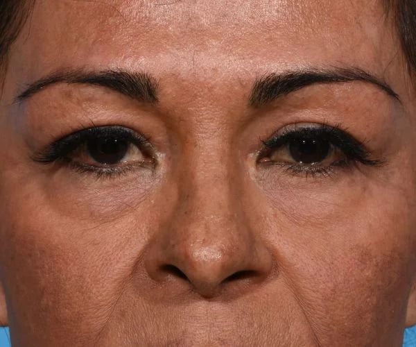 before brow lift front view female patient case 2103