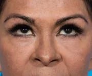 after brow lift front eyes up view female patient case 2103