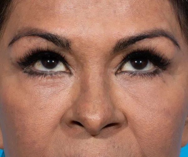 after brow lift front eyes up view female patient case 2103