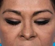 after brow lift front eyes closed view female patient case 2103