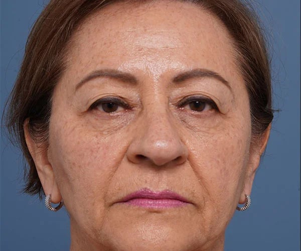 before brow lift front view female patient case 2116