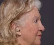 after brow lift right side view female patient case 2123