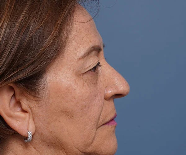 before brow lift right side view female patient case 2116