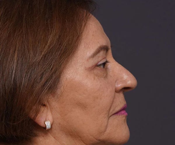 after brow lift right side view female patient case 2116