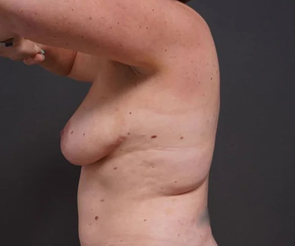 before breast augmentation left side arms up view female patient case 2048