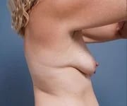 before breast lift right side arms up view female patient case 2373