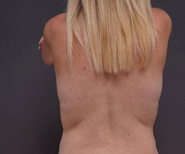 after breast lift back view female patient case 2373