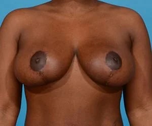 after breast lift with implants front view female patient case 2370