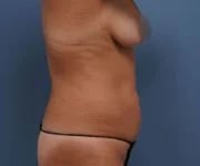 before tummy tuck right side view of female patient 2273
